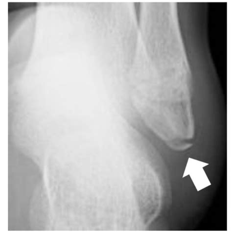 Pdf Diagnosis Of Avulsion Fractures Of The Distal Fibula After