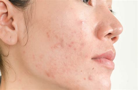 Troubled By Acne Issues Signs And Treatment In Sg 2022