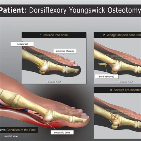 Dorsiflexory Youngstick Osteotomy Trialexhibits Inc