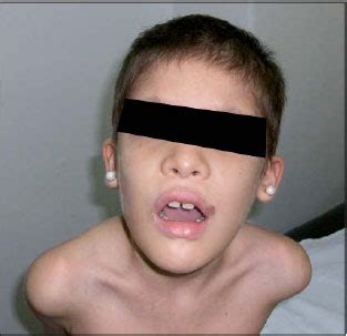 Hirschsprung disease mental retardation syndrome 12. Síndrome de Mowat-Wilson: caso clínico