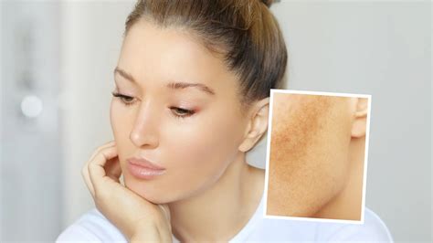 Teresa Paquin Best Skincare Ingredients For Treating Melasma Best