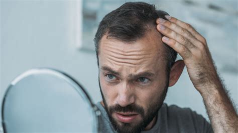 Four Effective Hair Loss Treatments For Men Hairskeen