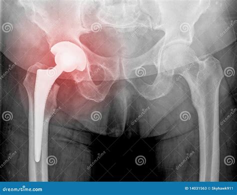 Hip Replacement X Ray 8 Weeks After Surgery Stock Photos Image 14031563