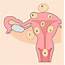 6 Types Of Uterine Fibroids And Symptoms Explained  YouMeMindBody
