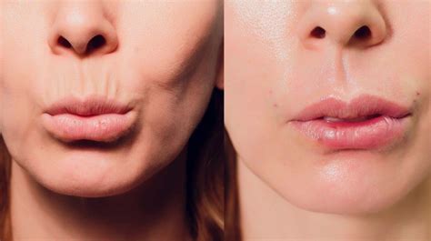 Lip Threading Procedure Benefits Risks Costs And Pictures How To