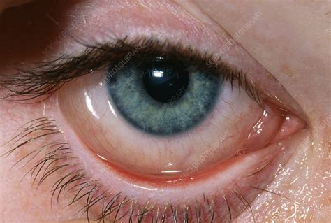 Allergic Conjunctivitis Stock Image M1550490 Science Photo Library