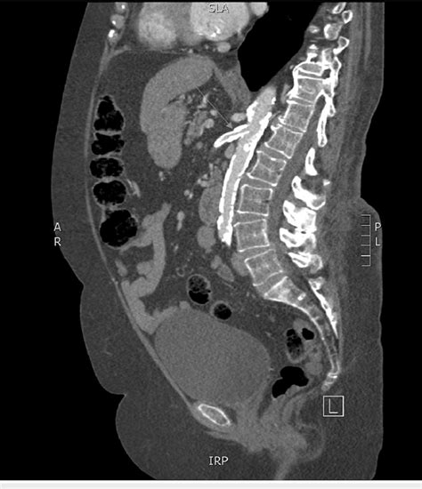 Sagittal Ct Of The Abdomen And Pelvis Without Contrast Demonstrating