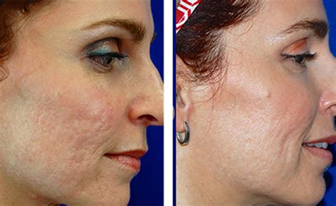 Acne Scars Laser Removal And Treatment Richmond Va Travis Shaw Md