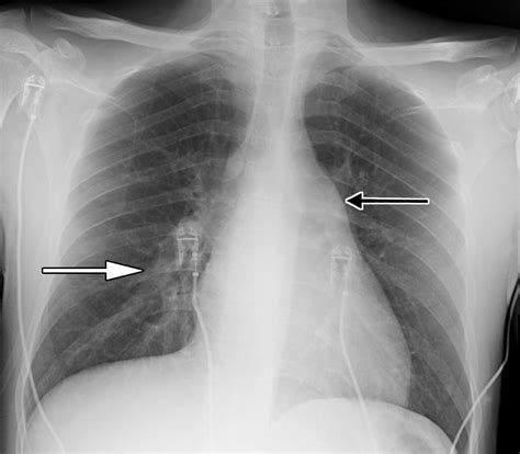 Case 276 Pulmonary Veno Occlusive Disease And Pulmonary Capillary