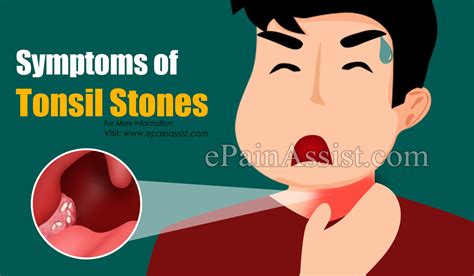 What Are Tonsil Stones Or Tonsilloliths Know Its Treatment Home