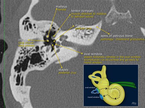 The Radiology Assistant Temporal Bone Anatomy 20