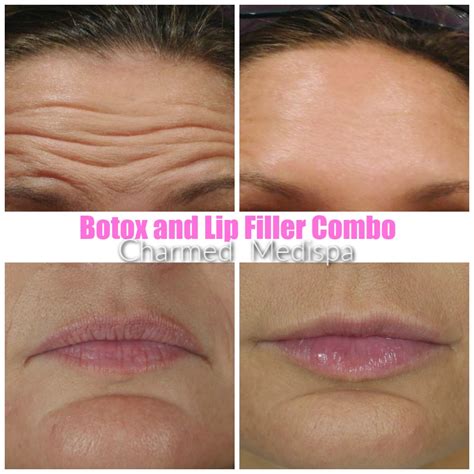 Botox And Lip Filler Transformation Charmed Medispa