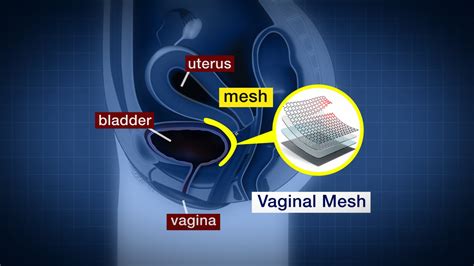 Vaginal Mesh Implants Lawsuit Against Johnson Johnson Set To