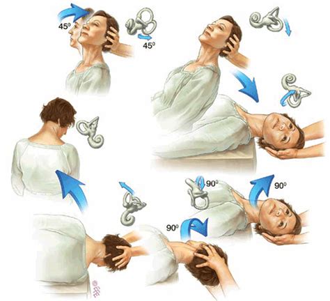 This post is the most comprehensive (yet easy to read) guide to epley maneuver you could find. The Epley manoeuvre | Epley maneuver, Vertigo, Physical ...