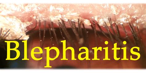 Natural Treatments Of Blepharitis Blepharitis Natural