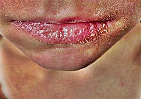 Crusty Lips Treatment Causes Symptoms