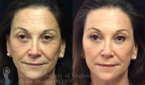 Skin Rejuvenation Treatments Before And After Your Magazine Lite