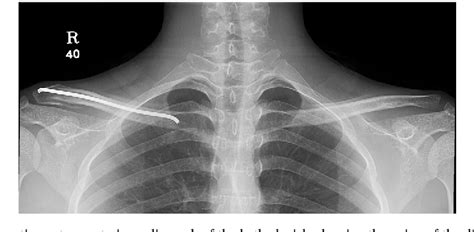 Figure 3 From Distal Clavicle Fracture Treated With A Titanium Elastic