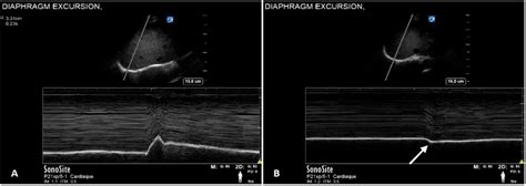 Scielo Brasil Hemidiaphragmatic Paralysis After Ultrasound Guided