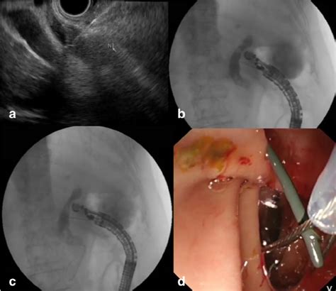 Eus Rendezvous Ercp In A Patient With Failed Common Bile Duct Cbd