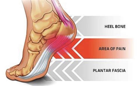 Physical Therapy And Plantar Fascia Pain Core Omaha Explains C O