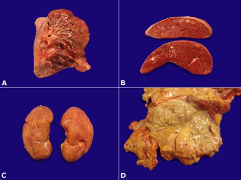 Most cases of lung cancer are associated with. Gross examination of: A-Lung parenchyma with nodules ...