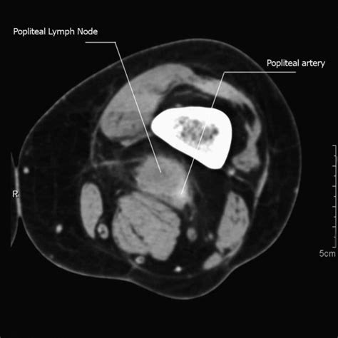 Incision For Popliteal Lymph Node Dissection Download Scientific Diagram