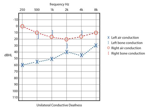 Audiometry is a key tool in uncovering, preventing or treating hearing loss. Hearing loss | enteducationswansea