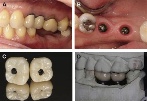Management Of Implantprosthodontic Complications Pocket Dentistry