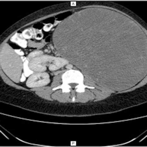 Pdf A Rare Case Of A Splenic Hamartoma In A Patient With A Huge