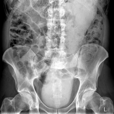 Rectal Foreign Bodies Radiology Reference Article Body Radiology Rectal
