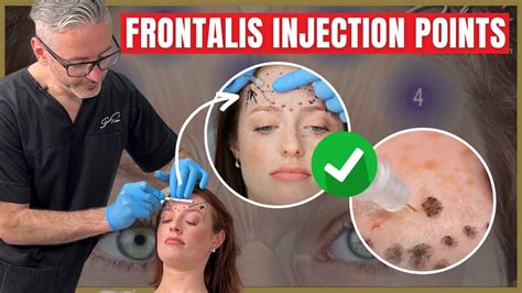 Injecting The Frontalis Botox Injection Points And Safety Advice Youtube
