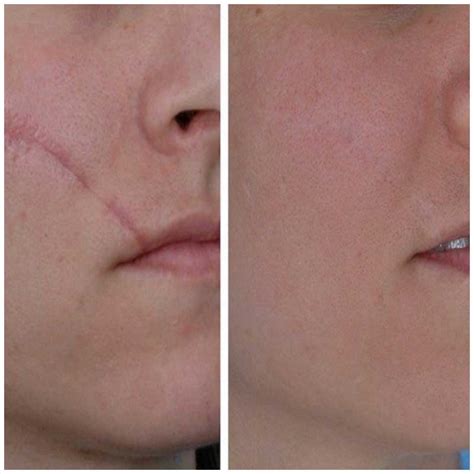 Keloid And Hypertrophic Scar Management Partners In Plastic Surgery