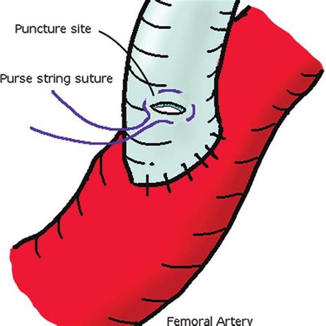 A And B Arch Aortogram Shows 84 Stenosis Of The Innominate Artery By