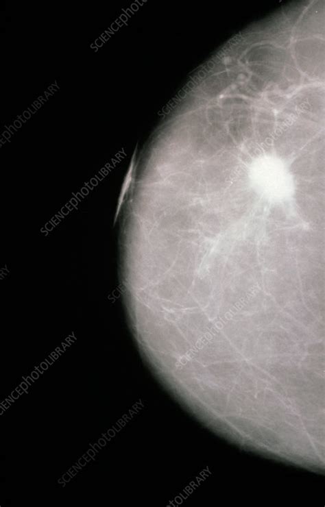 x ray mammogram showing evidence of breast cancer stock image m122 0050 science photo library