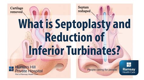 What Is Septoplasty And Reduction Of Inferior Turbinates Youtube
