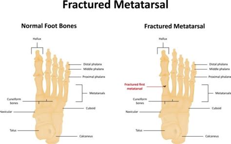 Metatarsal Fractures Causes Symptoms Diagnosis And Treatment Tips