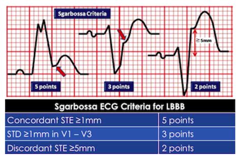 Validation Of The Modified Sgarbossa Criteria Core EM