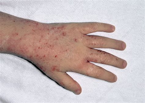 Eczema Bumps On Hands