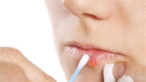 Mouth sores and inflammation (stomatitis) vary in the appearance and even the size and may affect any part of the. Cold Sore Remedies: How to Treat and Prevent Cold Sores on ...