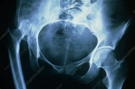 Tinted X Ray Of Dislocated Hip Stock Image M3500089 Science