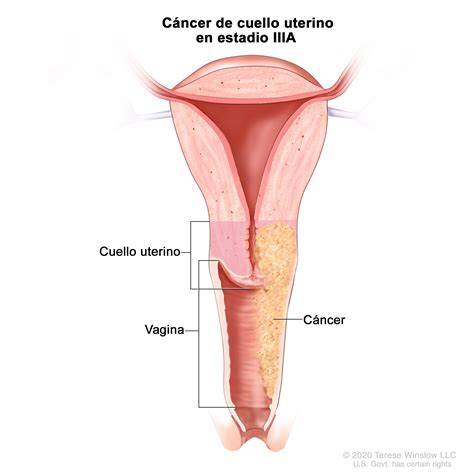 Actualizar 63 Dibujo Del Cuello Del Utero Vn