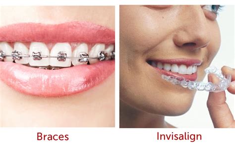 Treatment duration depending on your individual circumstances, you'll likely have your braces or aligners anywhere between six months to two years before you get your desired results. Perth Leading Dentist Reveals Top 10 Things You MUST Know ...