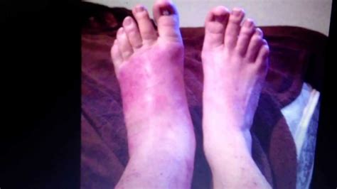 Cellulitis Of The Foot Youtube