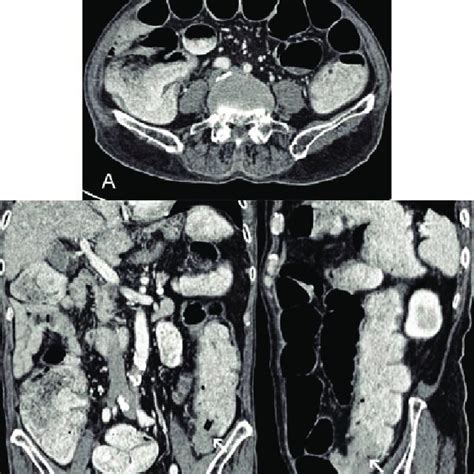Ct Scan In A 79 Year Old Man With History Of Vomiting And Constipation
