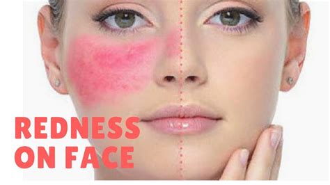 Pin By Mariyam Jameel On Unbelievable Trick How To Get Rid Of Redness