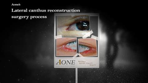 Aone S Lateral Canthus Reconstruction Surgery Process Youtube