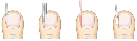 Partial Nail Avulsion Permanent And Non Permanent Perform Podiatry