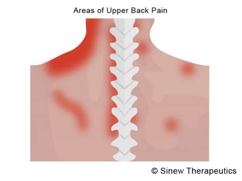 Upper Back Muscle Strains Information Sinew Therapeutics