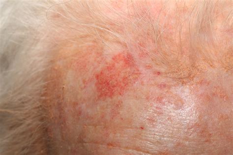 Spots On Skin Keratosis Treatment Sexiz Pix